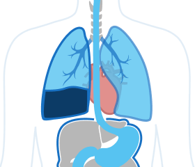 Pleural Effusion