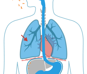 Asbestos Fibers embedded in the pleural membrane.