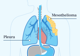 Pleural Mesothelioma Illustration