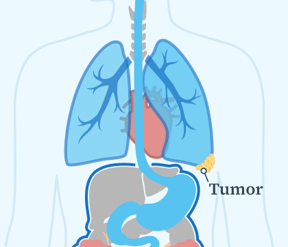 Stage 1 Mesothelioma Illustration