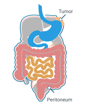 Stage 1 of Peritoneal Mesothelioma