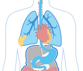 Illustration of Stage 3 Pericardial Mesothelioma