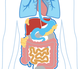 Illustration of Stage 3 Peritoneal Mesothelioma