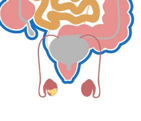 Illustration of Stage 3 Testicular Mesothelioma