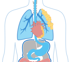 Illustration of Stage 3A Pleural Mesothelioma