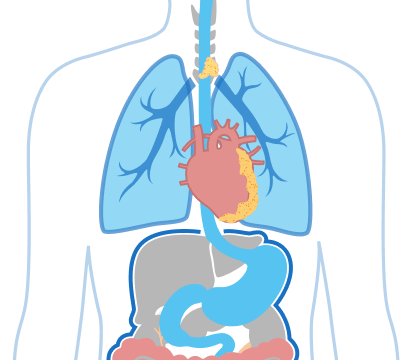 Stage 4 Pericardial Mesothelioma Illustration