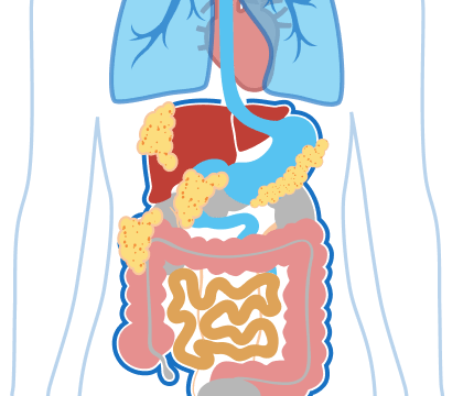 Stage 4 Peritoneal Mesothelioma Illustration