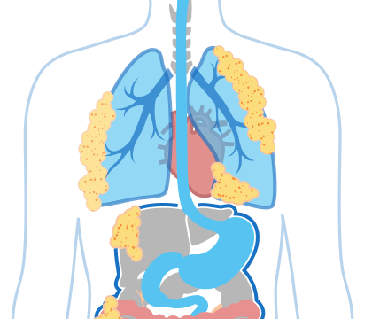 Stage 4 Pleural Mesothelioma Illustration