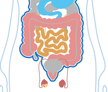 Stage 4 Testicular Mesothelioma Illustration