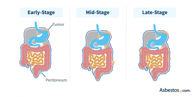 Illustration of staged progression of peritoneal mesothelioma. Early-stage tumors are localized in one area of the peritoneal lining. Mid-stage peritoneal mesothelioma may be more extensive and involve deeper tissues or lymph nodes. Late-stage cancer has spread to distant structures in the abdomen.