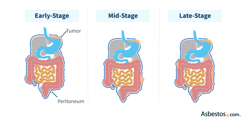 peritoneal-mesothelioma-treatment-prognosis-diagnosis