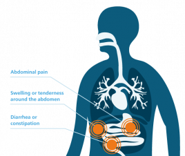 Symptoms of peritoneal mesothelioma graphic