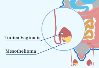 Testicular Mesothelioma Illustration