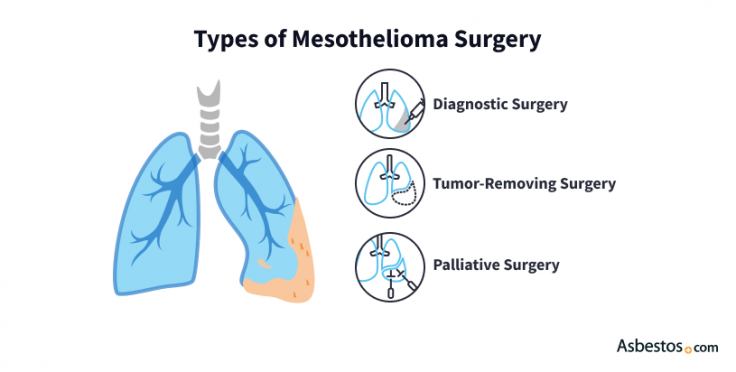 Types of mesothelioma surgery include diagnostic, tumor removal and palliative.