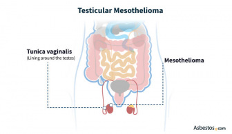 Diagram showing the location of testicular mesothelioma