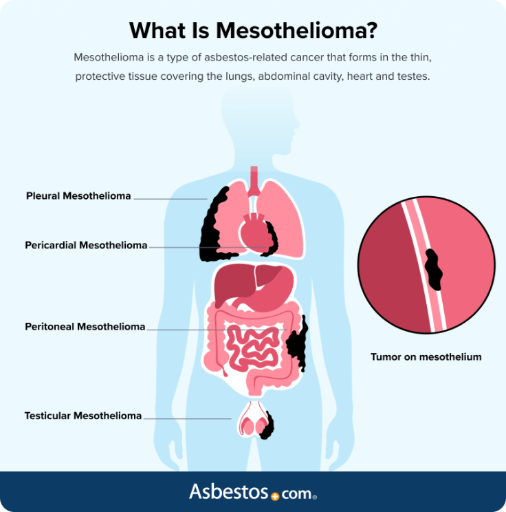 What mesothelioma is and where different types occur in the body
