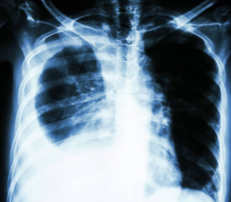 film chest X-ray PA upright : show pleural effusion at right lung due to lung cancer.