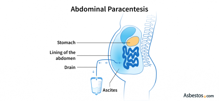 Ascites Drainage Diagram