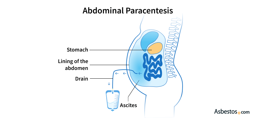 Paracentesis Procedure