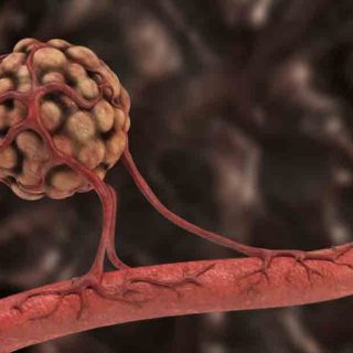 Example of angiogenesis — the formation of new blood vessels