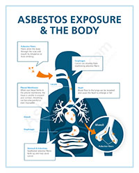Mesothelioma veterans benefits Mesothelioma veterans benefits