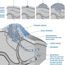 Progression of mesothelioma tumor formation