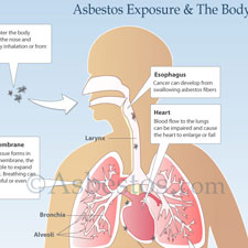 Asbestos in the body diagram