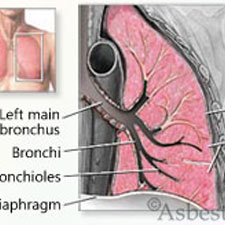 Asbestos lung diagram