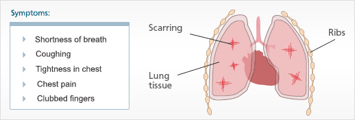 Asbestosis and Asbestosis Symptoms