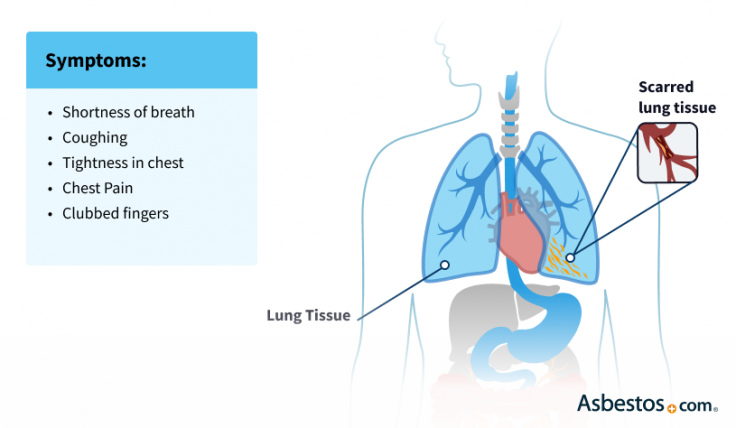 Asbestosis and Asbestosis Symptoms