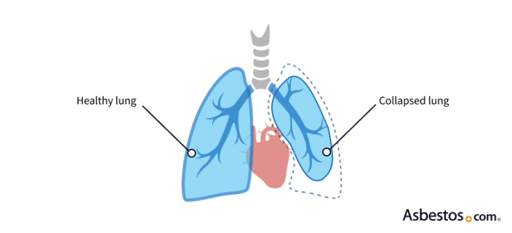 Atelectasis Caused by Asbestos