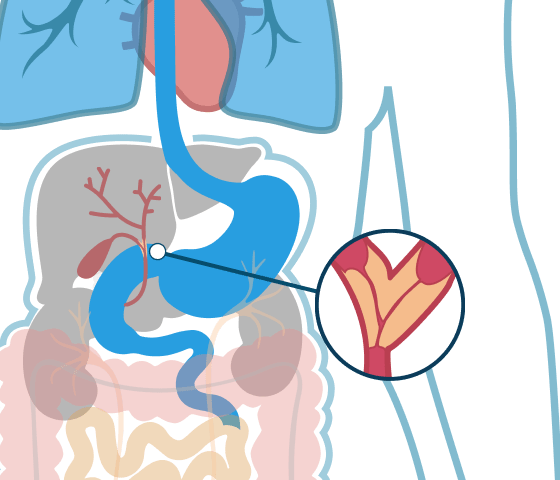 Bile Duct Cancer