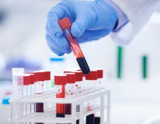 Lab test for cancer