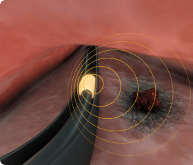 Brachytherapy example
