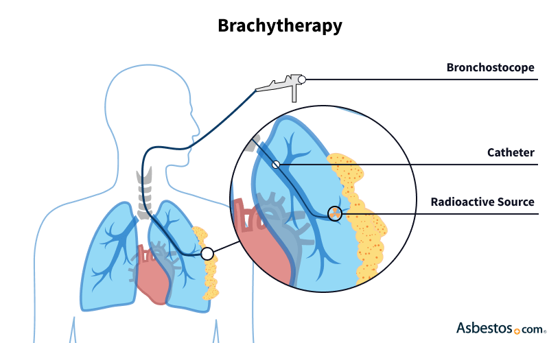 Brachytherapy treatment for pleural mesothelioma
