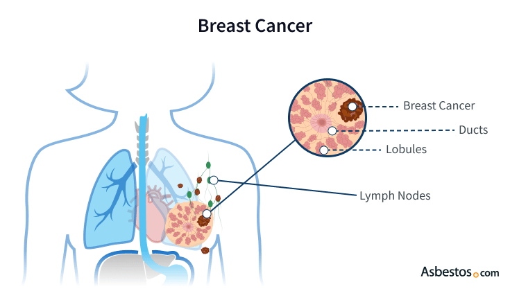 Cancer in the breast with nearby ducts, lobules and lymph nodes