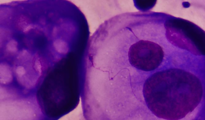 Malignant cells in pleural fluid