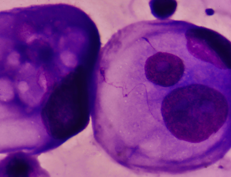 Malignant cells in pleural fluid