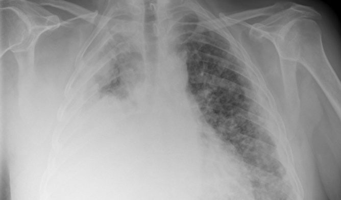 Chest X-ray showing mesothelioma