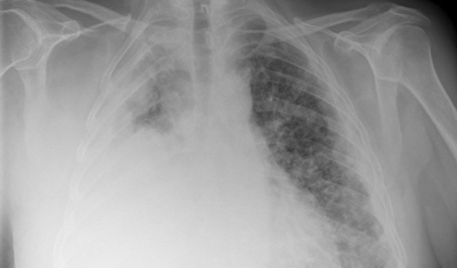 mesothelioma cancer of pleura