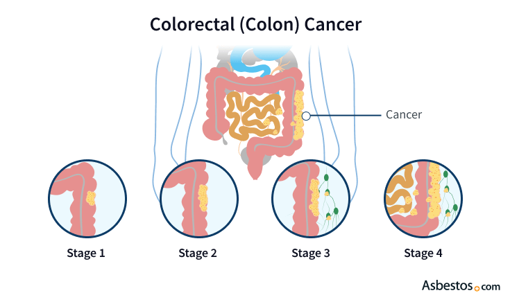 Stages of colorectal cancer