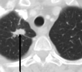CT scan of lung cancer