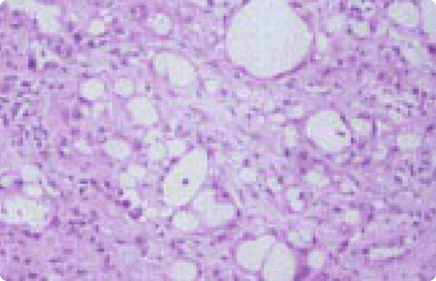 Cystic mesothelioma cells under microscope