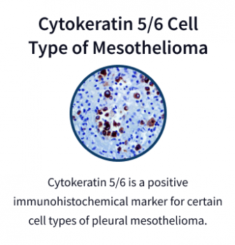 Cytokeratin 5/6 mesothelioma cells under microscope