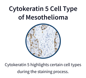 Cytokeratin 5 mesothelioma cells under microscope