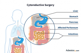 Cytoreductive surgery for peritoneal mesothelioma