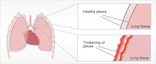 Diffuse Pleural Thickening