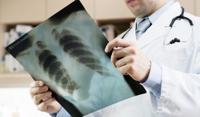 Doctor showing x-ray of lungs. hospital. medical check.