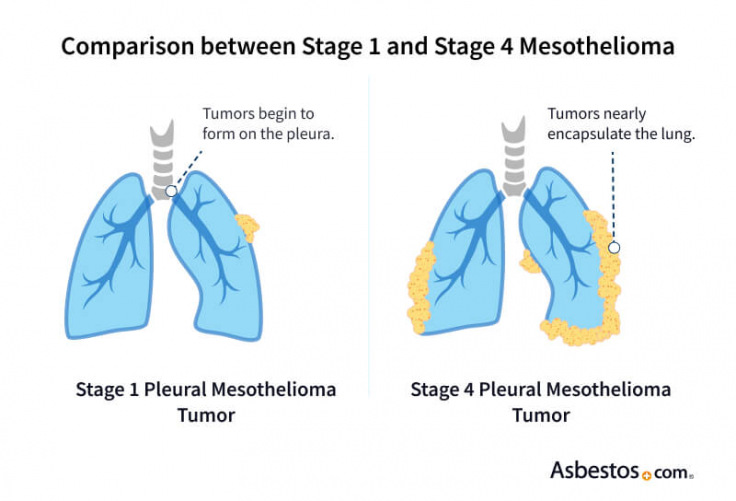 Comparison between stage 1 and stage 4 pleural mesothelioma