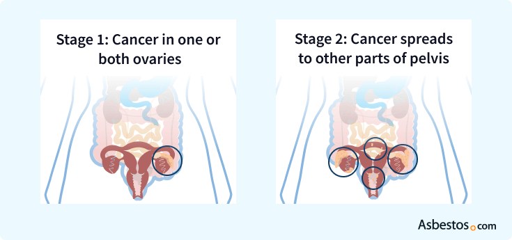 Comparing stage 1 and stage 2 ovarian cancer